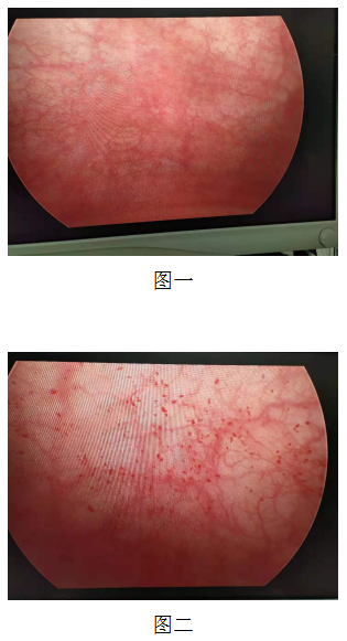 间质性膀胱炎最新疗法研究与应用进展