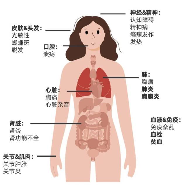 新澳门心水版论坛_红斑狼疮每次复发都是重创