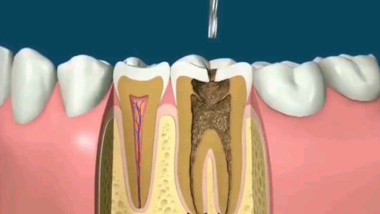 最新口腔根管治疗视频,最新口腔根管治疗视频，你的口腔健康我来守护！🦷✨