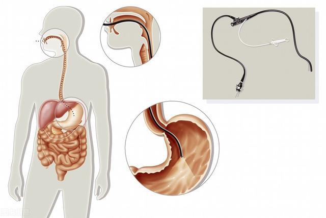 科技重塑健康，最新胃镜检查不插管，体验未来医疗的魅力