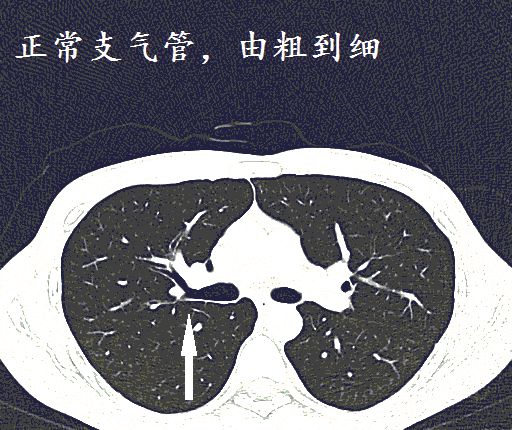 最新支气管扩张治疗技术